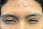 Botox (20 Units) Case 4 After