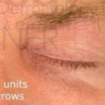 Botox (25 Units) Case-6 After