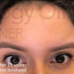 Botox (15 Units) Case 7 After
