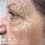 Botox (20 Units) Case-8 After