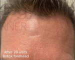 Botox (20 Units) Case 9 After