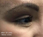 Botox (20 Units) Case 10 After