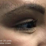 Botox (20 Units) Case 10 After