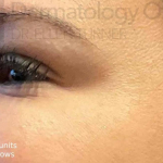 Botox (25 Units) Case 14 After