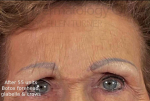 Botox (55 Units) Case 15 After