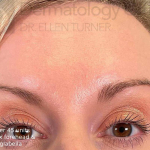 Botox (45 Units) Case 16 After