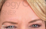 Botox (75 units) Case-17 After