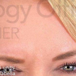 Botox (75 units) Case-17 After