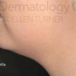 Kybella (2 Series) Before and After Case 2 After