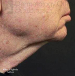 Kybella (2 Series) Before and After Case 3 After