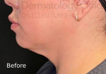 Kybella (1 Series) Before and After Case 4 Before