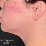 Kybella (1 Series) Before and After Case 4 After