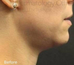 Kybella (1 Series) Before and After Case 5 Before
