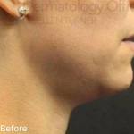 Kybella (1 Series) Before and After Case 5 Before