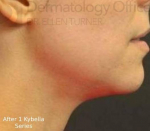Kybella (1 Series) Before and After Case 5 After