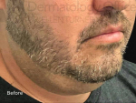 Kybella (2 Series) Case-6 Before