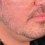 Kybella (2 Series) Case-6 After