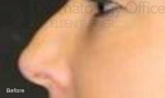 Injectable Rhinoplasty (1 Syringe) Before and After Case 1 Before
