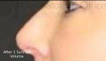 Injectable Rhinoplasty (1 Syringe) Before and After Case 1 After