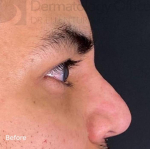 Injectable Rhinoplasty (1 Syringe) Before and After Case 3 Before