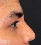 Injectable Rhinoplasty (1 Syringe) Before and After Case 3 After