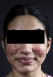 Acne Before and After Case 8 Before