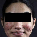Acne Before and After Case 8 Before