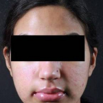 Acne Before and After Case 8 After