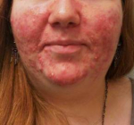 Acne Before and After Case 1 Before