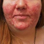 Acne Before and After Case 1 Before