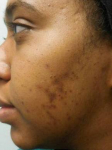 Acne Before and After Case 9 Before