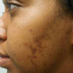Acne Before and After Case 9 Before