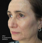 EMFACE (4 treatments) Before and After Case-10 After