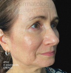 EMFACE (4 treatments) Before and After Case-12 After