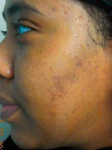 Acne Before and After Case 9 After