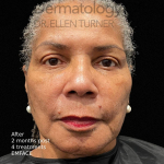 EMFACE (4 treatments) Before and After Case-13 After