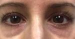 Restylane<sup>®</sup> Before and After Case 1 Before