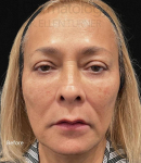 EMFACE (1 treatment) Before and After Case-24 Before