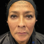 EMFACE (1 treatment) Before and After Case-24 After