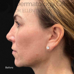 EMFACE (4 treatments) Before and After Case-26 Before