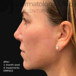 EMFACE (4 treatments) Before and After Case-26 After
