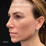 EMFACE (4 treatments) Before and After Case-27 Before