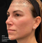 EMFACE (4 treatments) Before and After Case-27 After