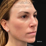 EMFACE (4 treatments) Before and After Case-29 Before