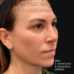 EMFACE (4 treatments) Before and After Case-29 After