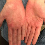 Allergic Contact Dermatitis Before and After Case 3 Before