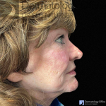 EMFACE (4 treatments) Before and After Case-39 Before