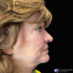 EMFACE (4 treatments) Before and After Case-39 After