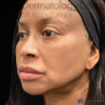 EMFACE (4 treatments) Before and After Case-18 After