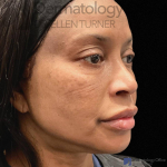 EMFACE (4 treatments) Before and After Case-19 After
